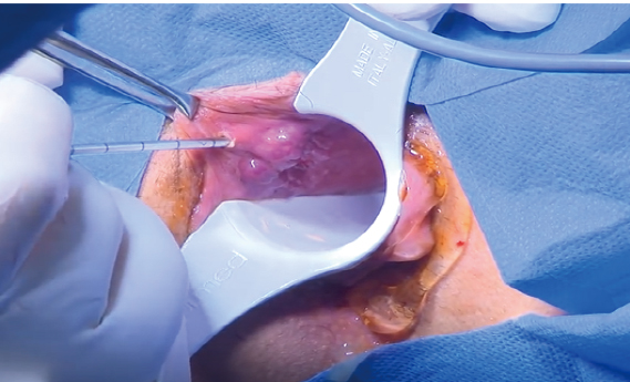 Laser for Hemorrhoid Surgery Clinical Application