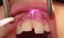 dental laser fiber
