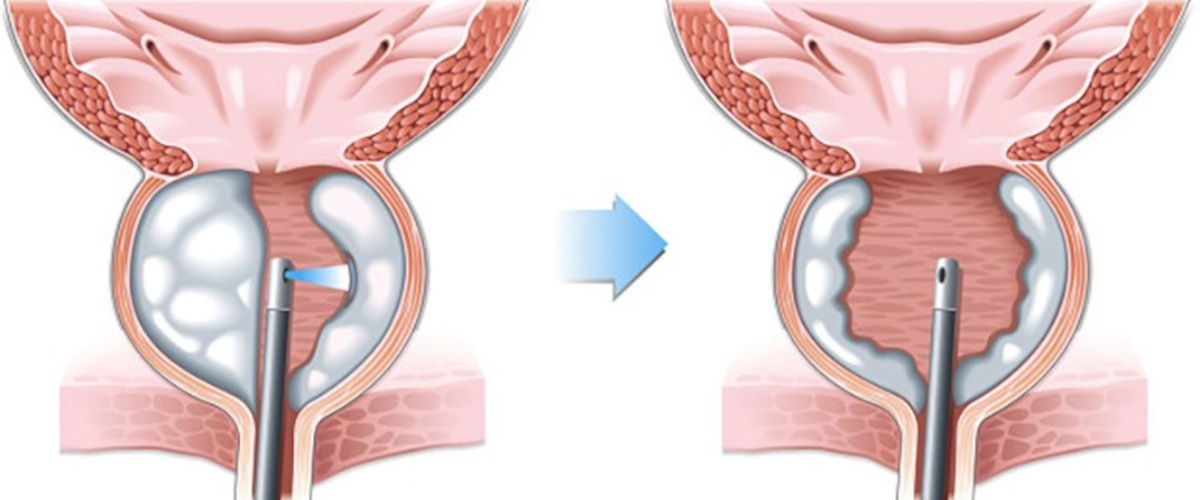 A Systematic Review of Holmium Laser Prostatectomy for Benign Prostatic Hyperplasia